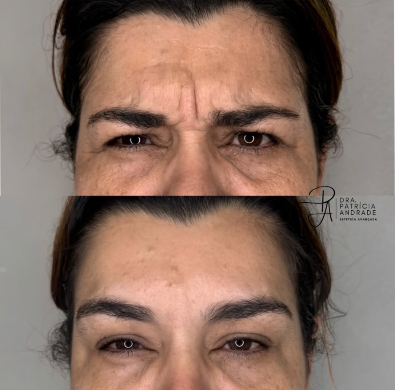 Resultado — Botox