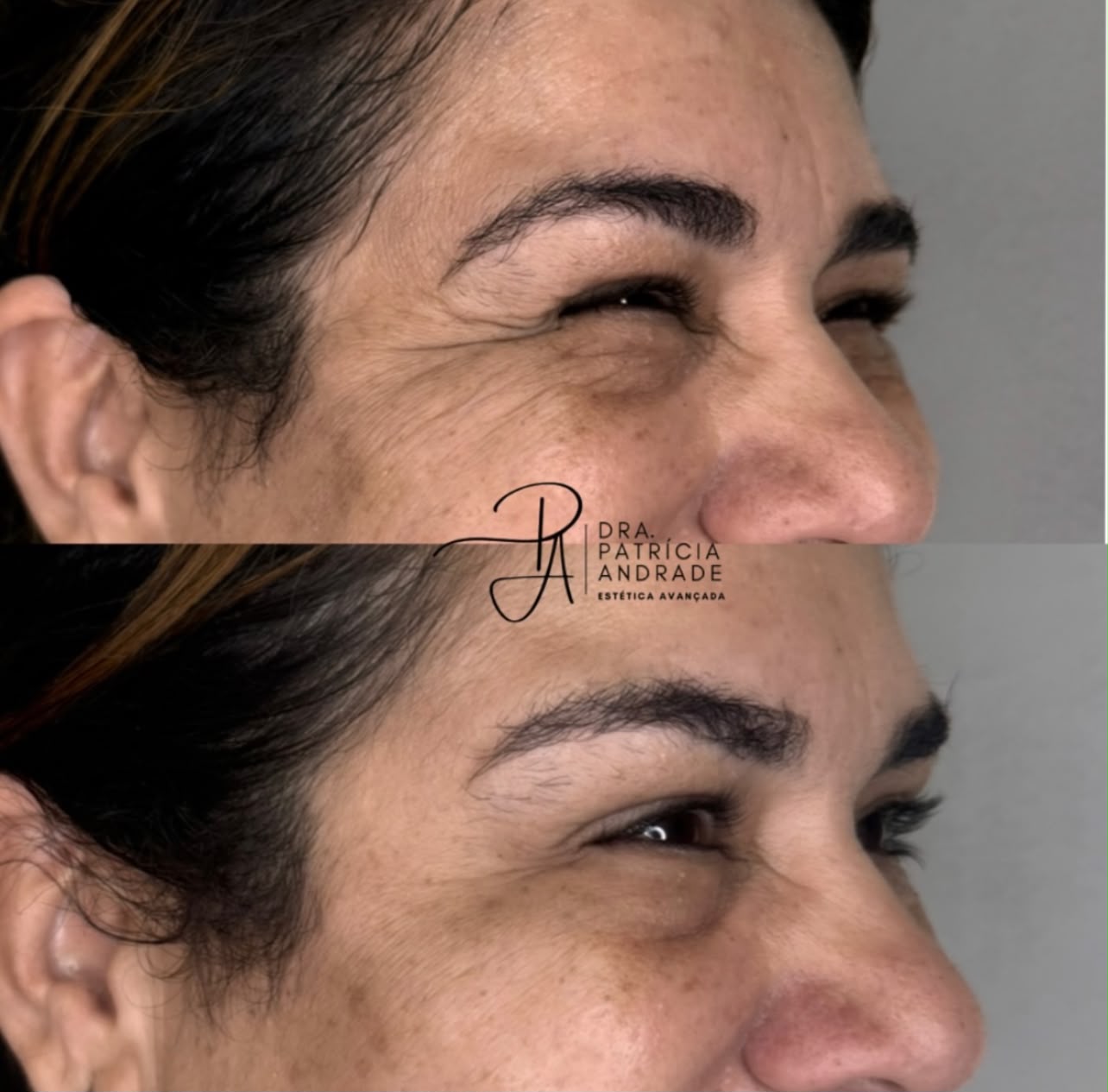Resultado — Botox
