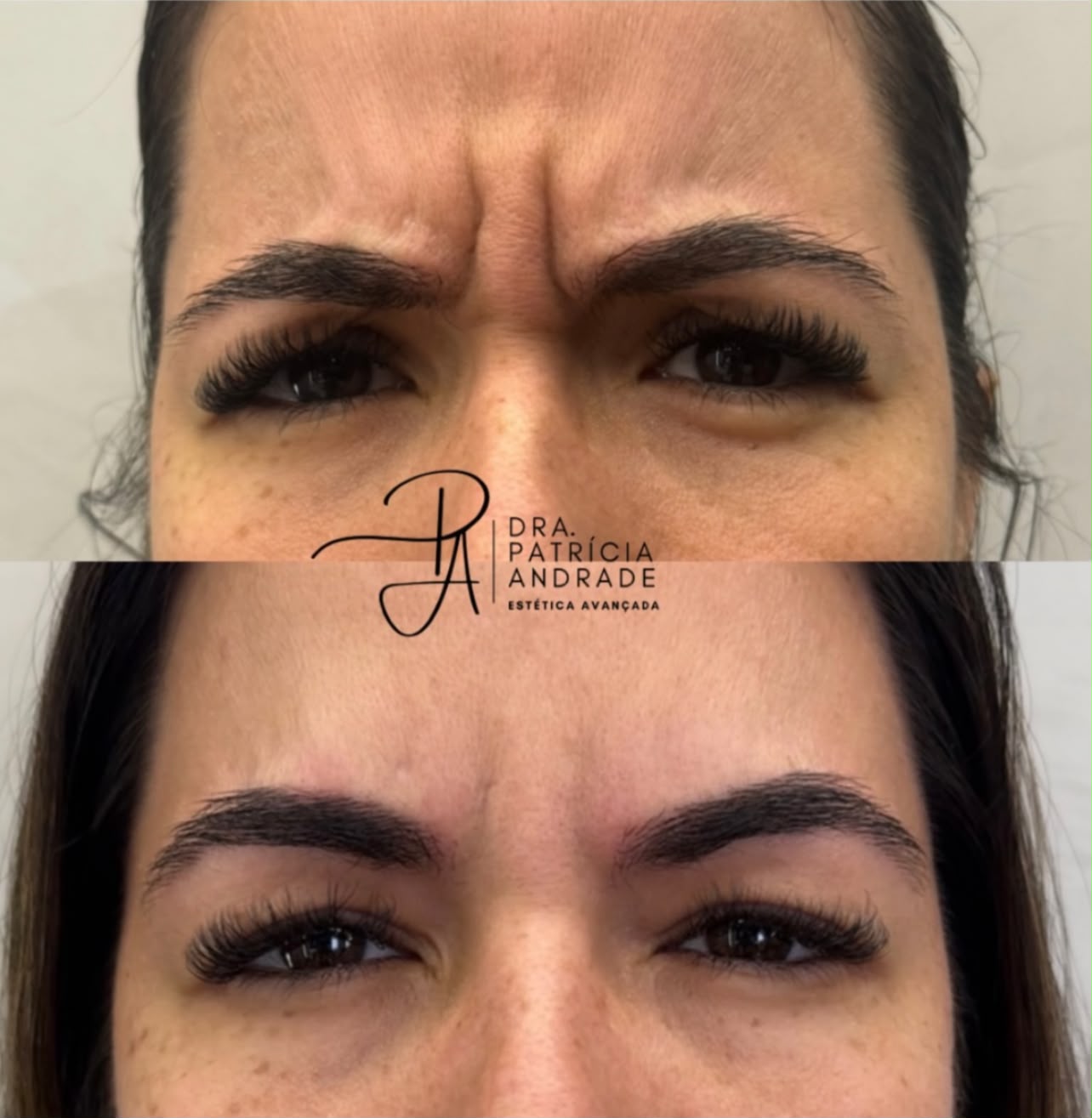 Resultado — Botox