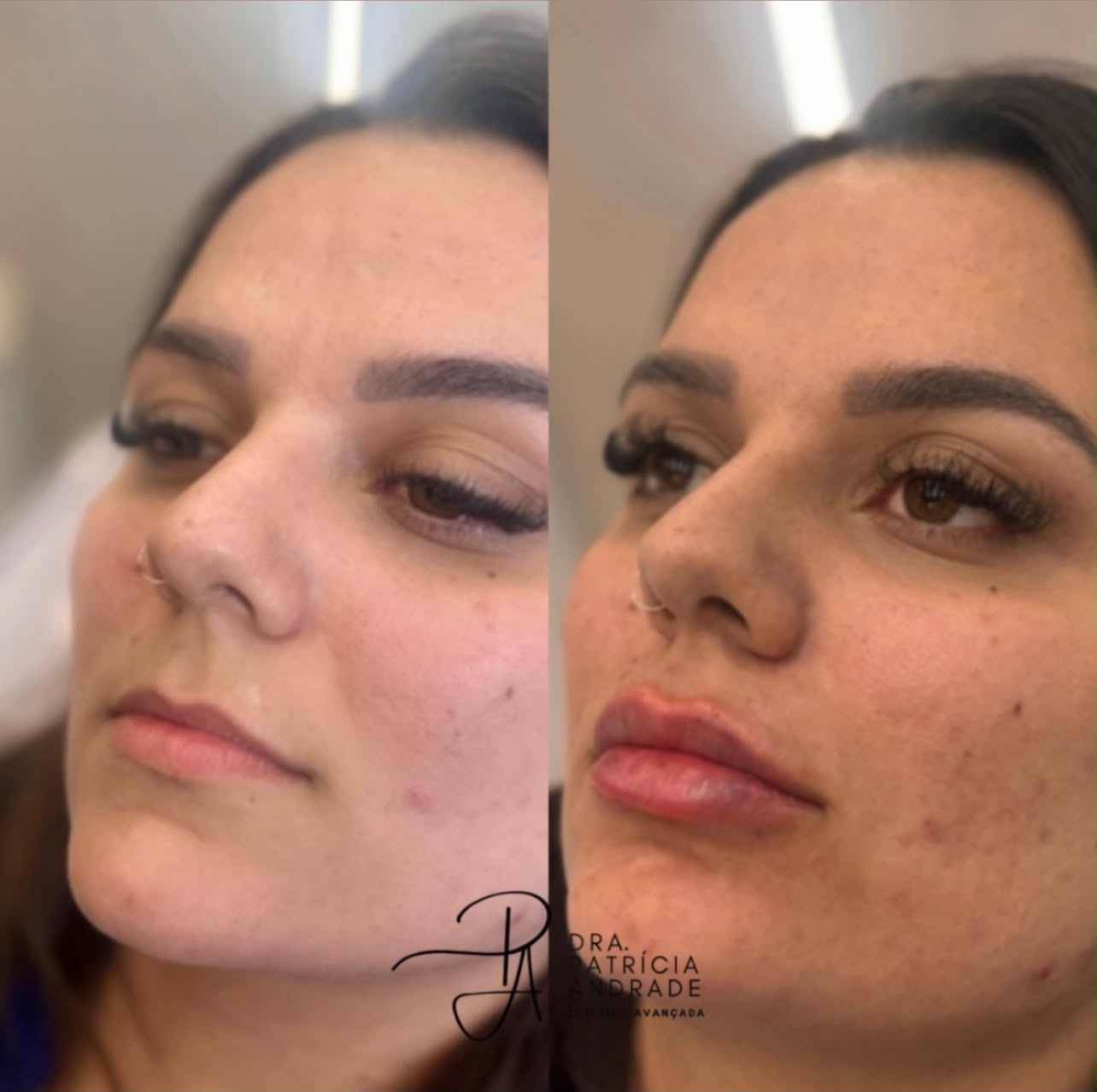 Resultado — Preenchimento Labial