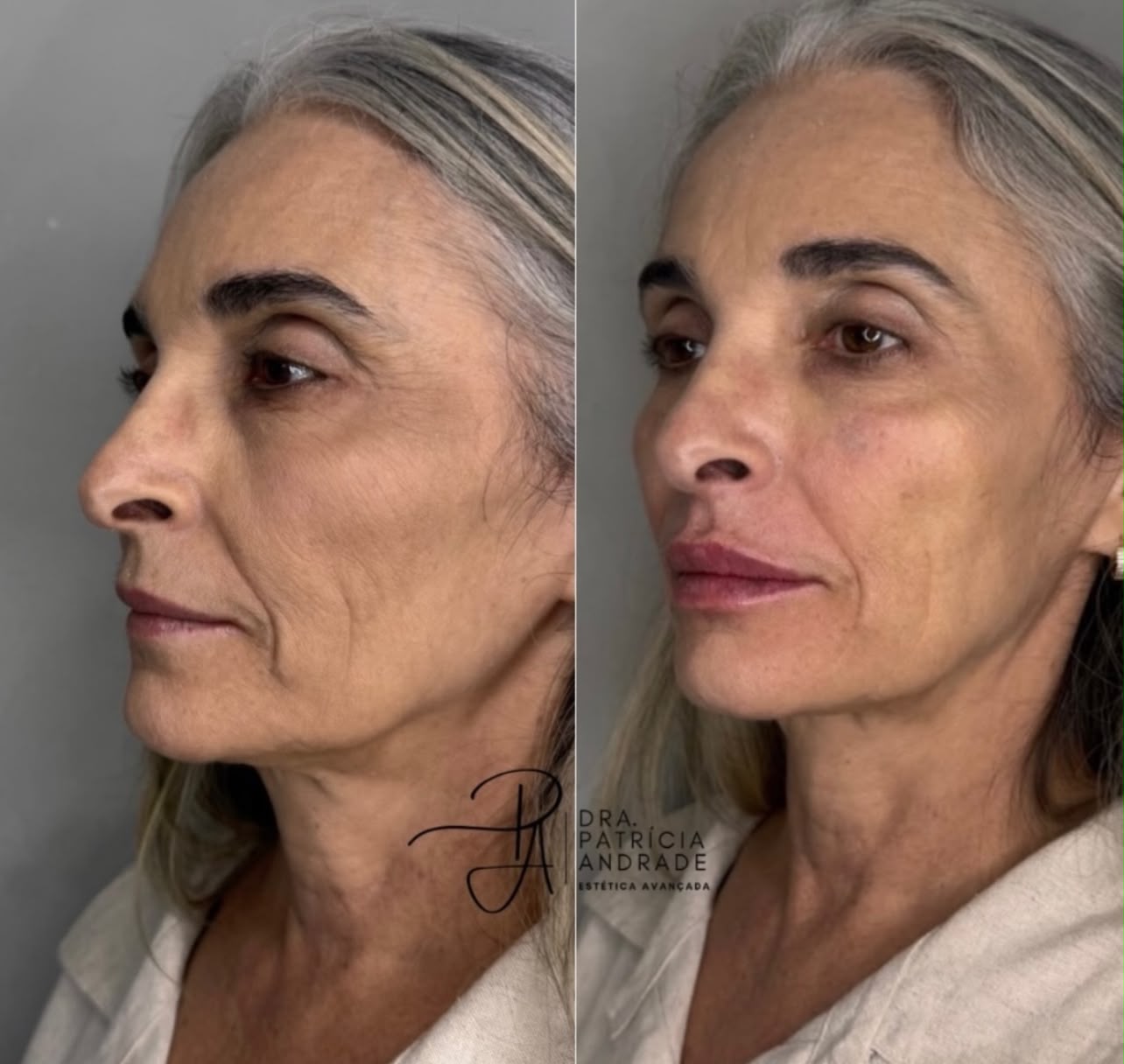 Resultado — Preenchimento Labial