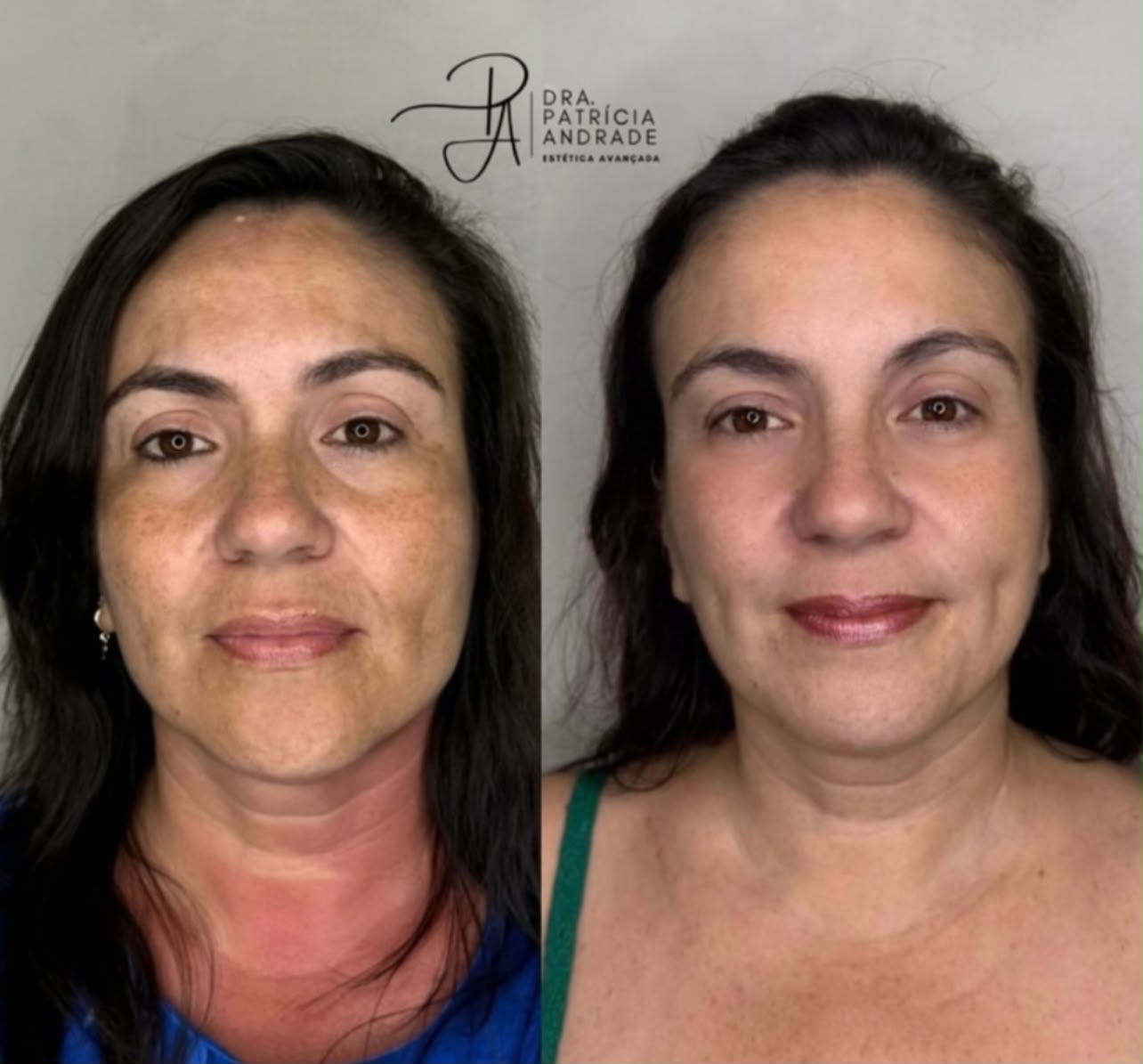 Resultado — Melasma